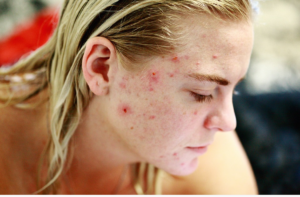 cbd can treat acne
